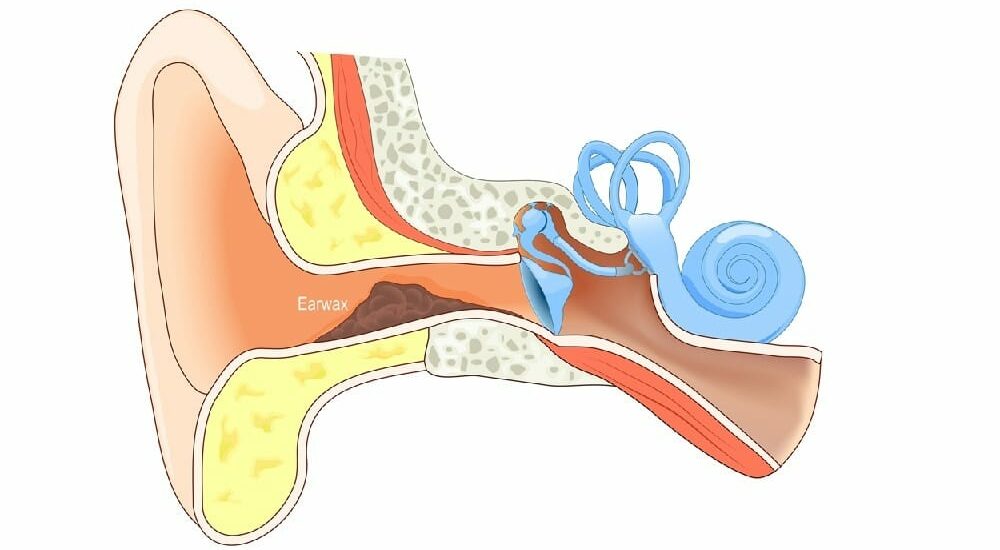 cáncer,cerumen,diagnóstico precoz