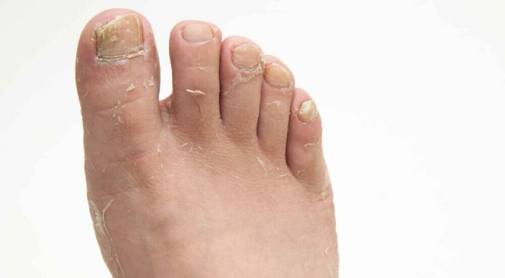 dermatofitos,resistencia a terapia