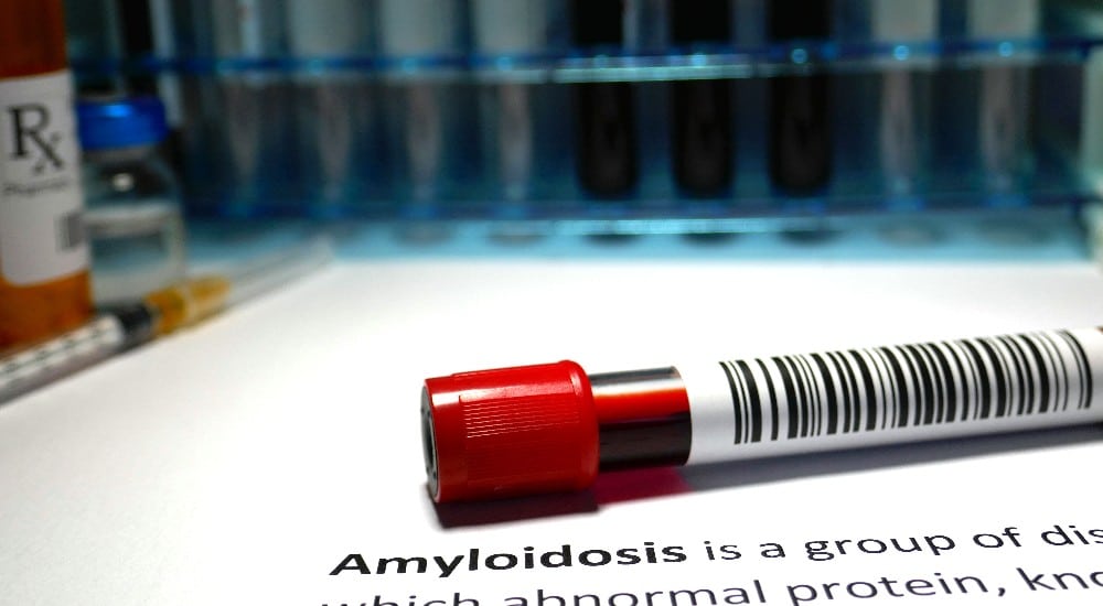 biomarcadores de amiloidosis,Inteligencia Artificial para amiloidosis